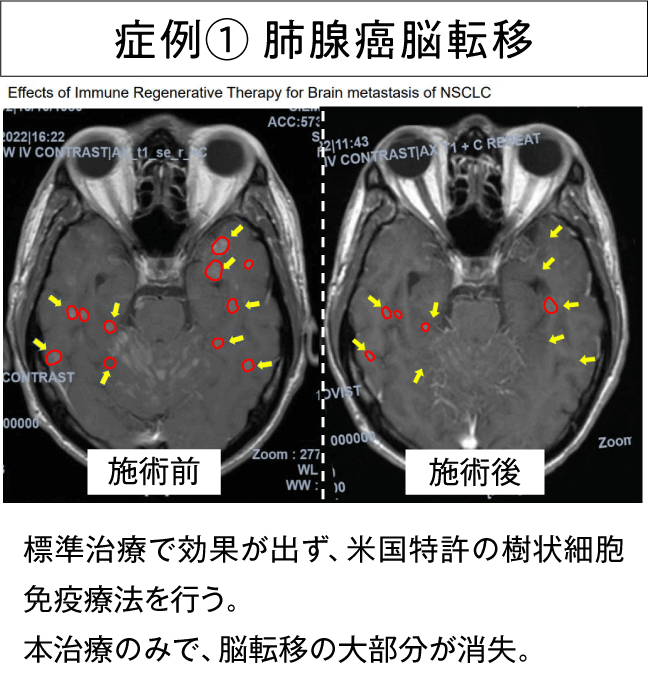 治療例1