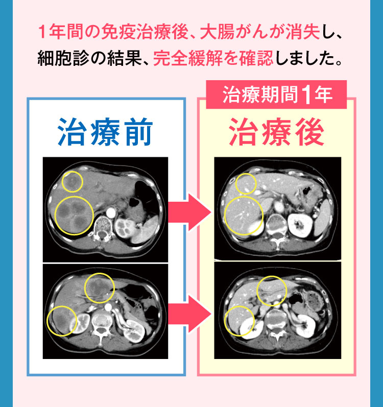 1年間の治療で大腸がんが消失し、細胞診の結果完全緩解を確認しました