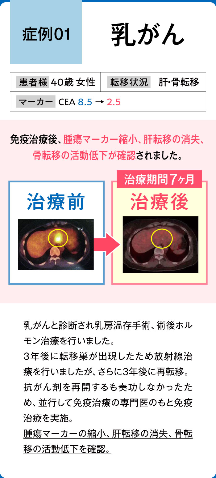 乳がん症例1