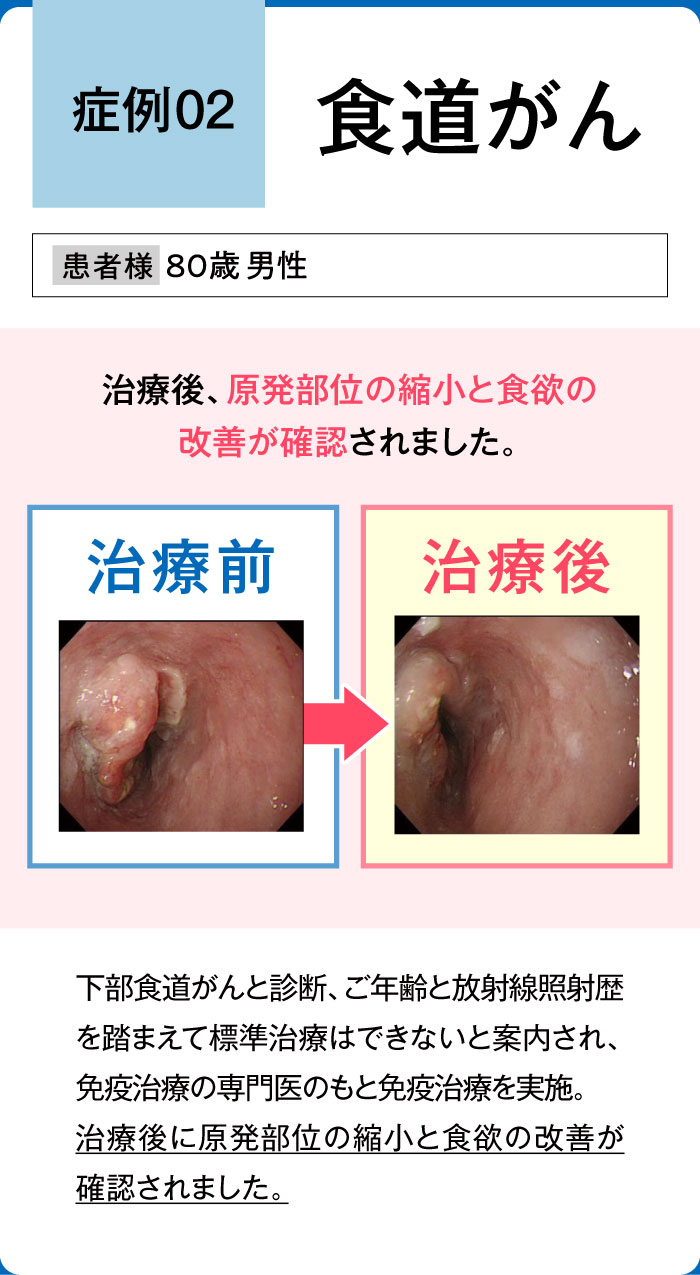 食道がん症例2