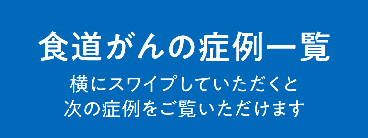 食道がんの症例一覧