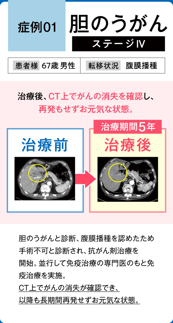 胆のうがん症例1