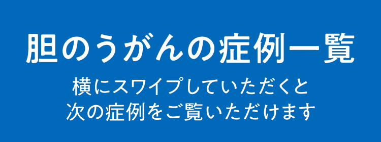 胆のうがんの症例一覧