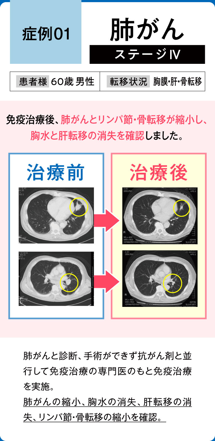 肺がん症例1