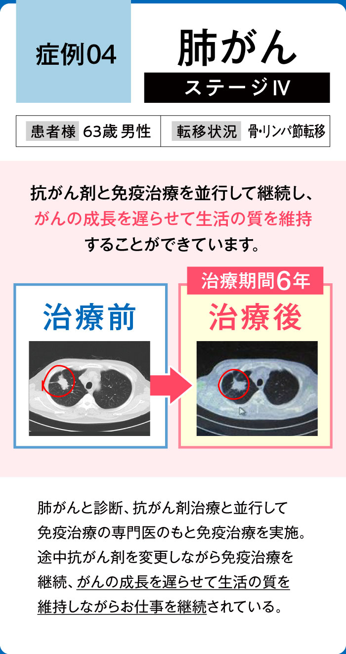 肺がん症例4