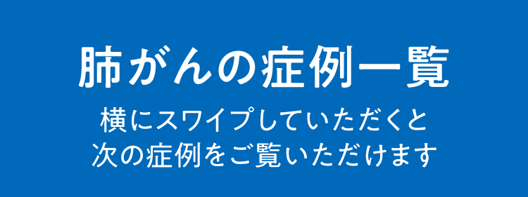 肺がんの症例一覧