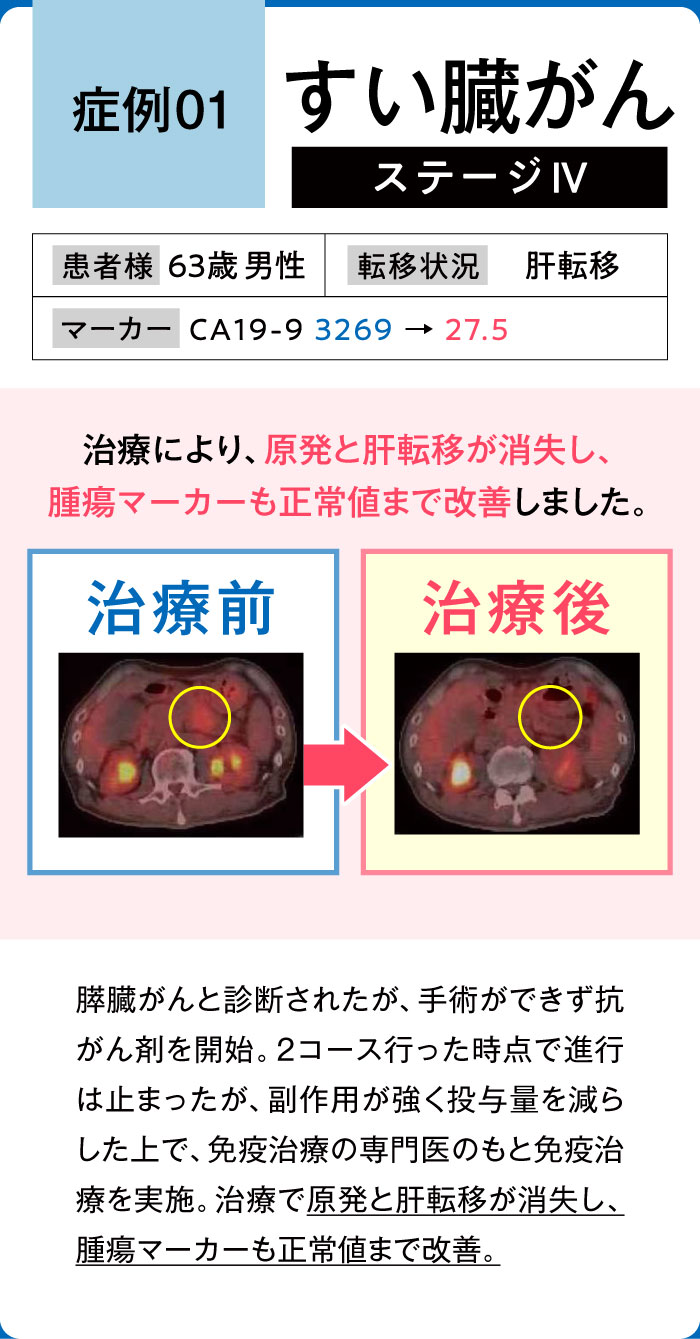 すい臓がん症例1
