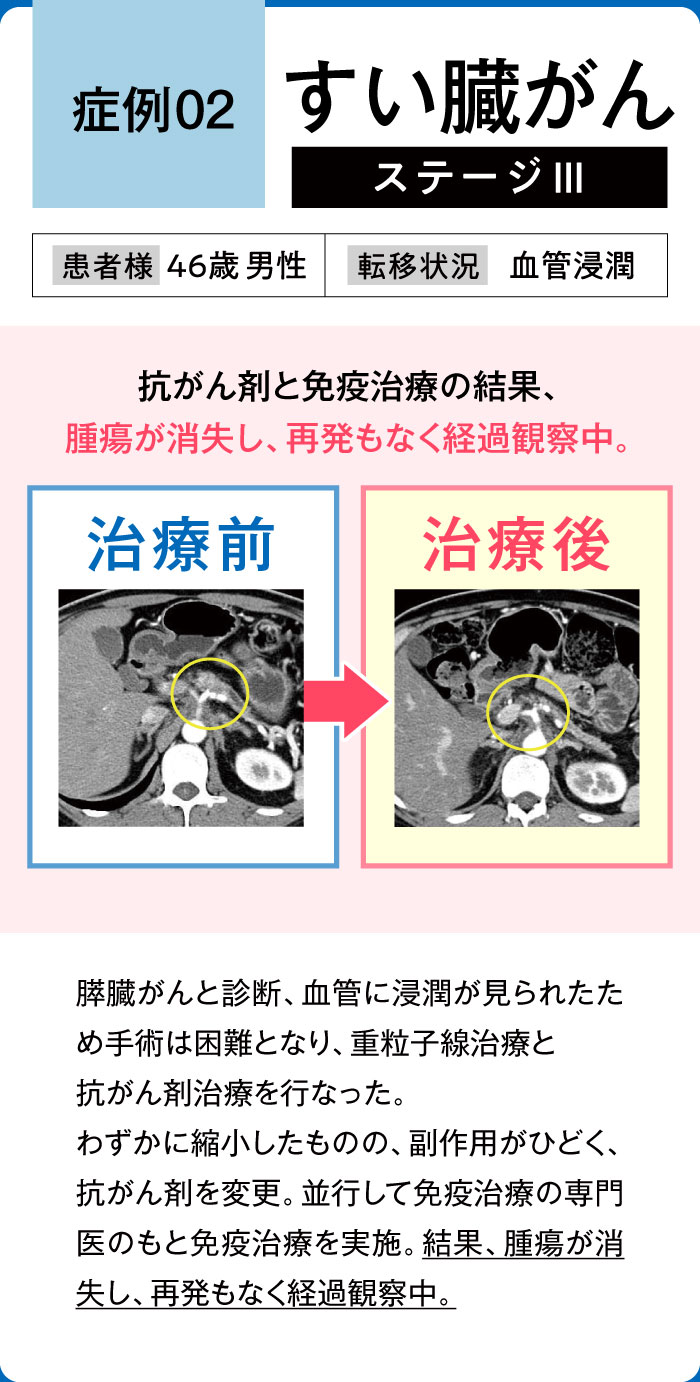 すい臓がん症例2