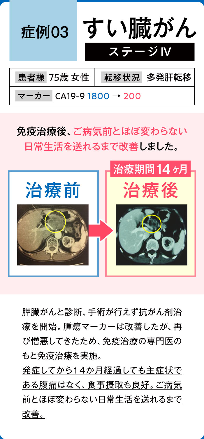すい臓がん症例3