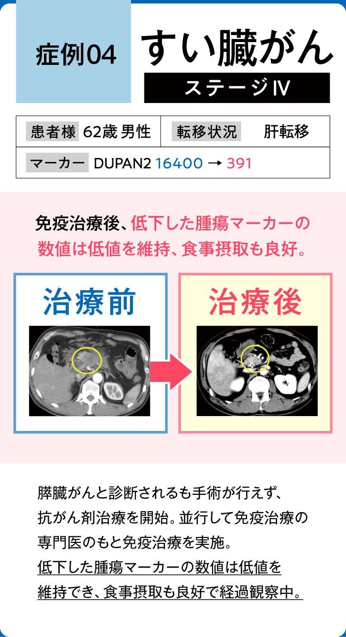 すい臓がん症例4