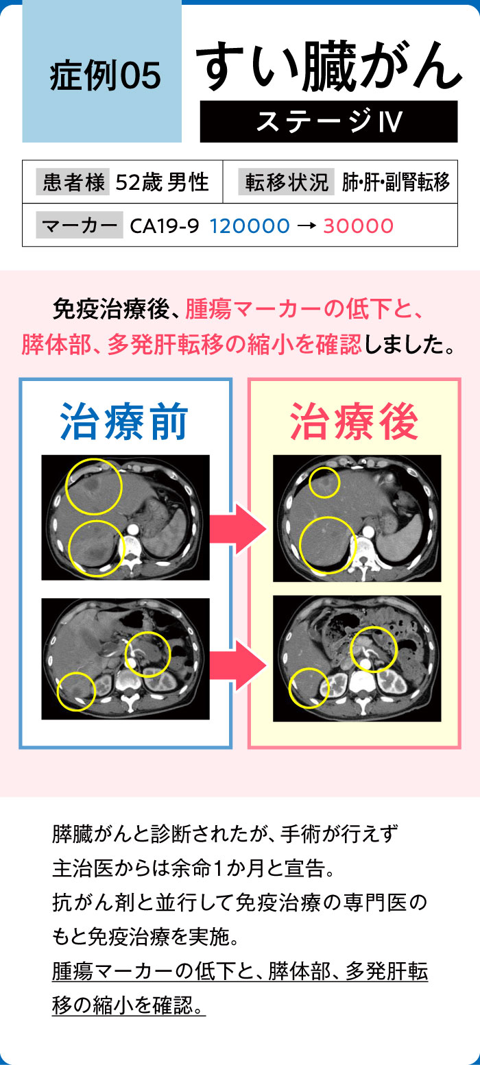 すい臓がん症例5