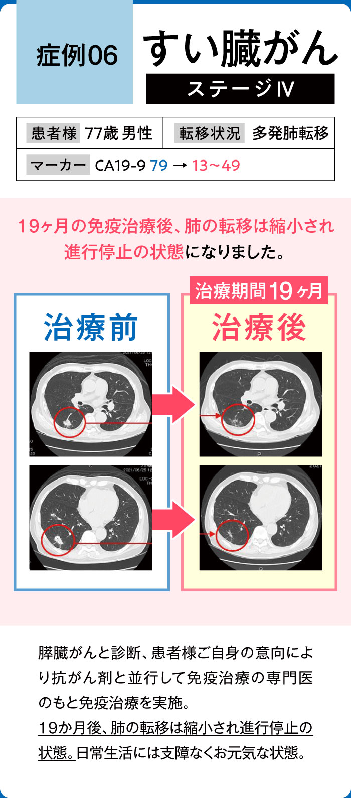 すい臓がん症例6