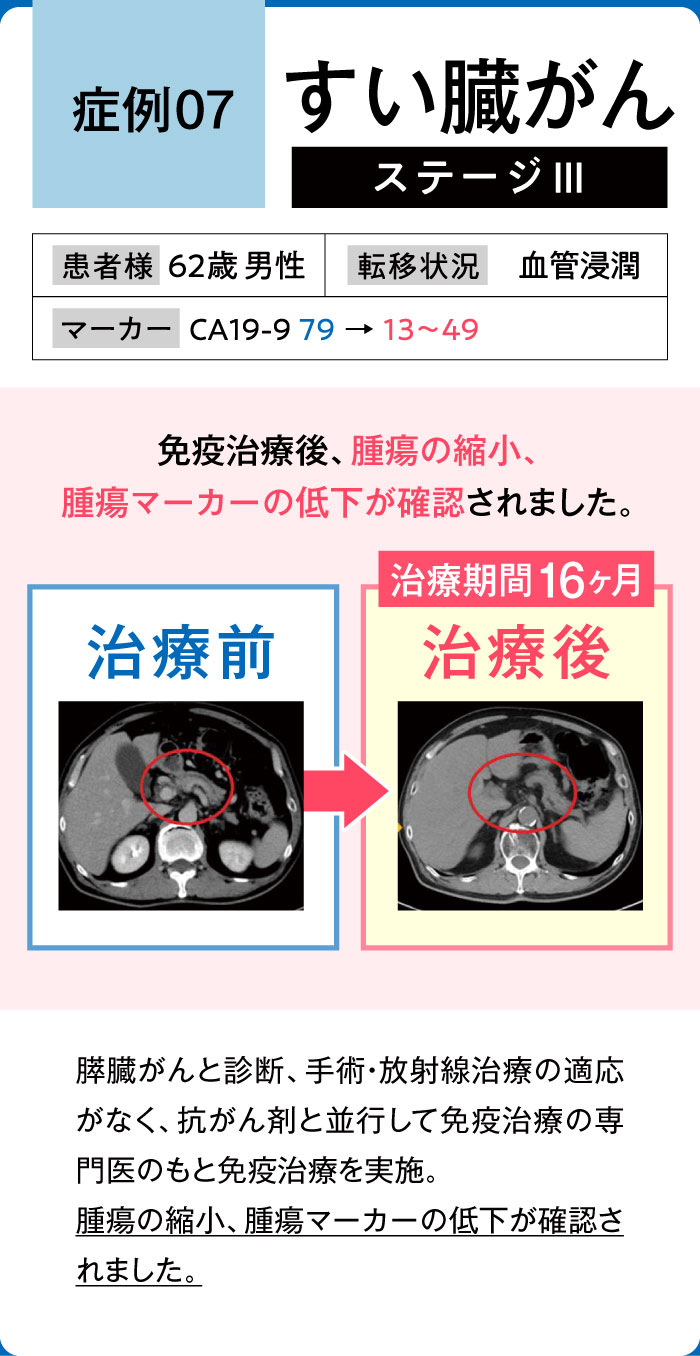すい臓がん症例7