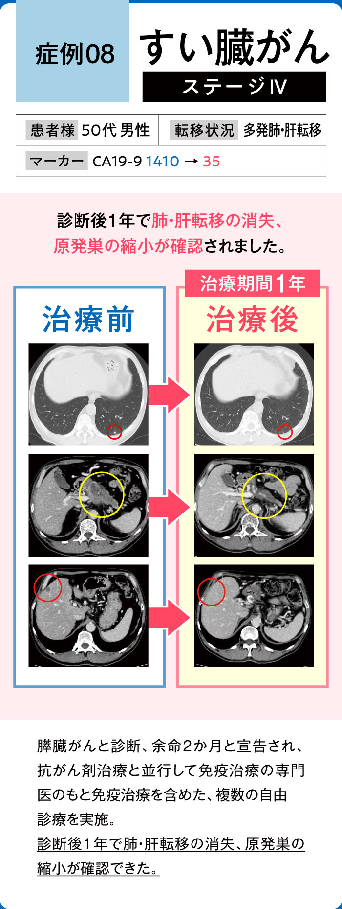 すい臓がん症例8
