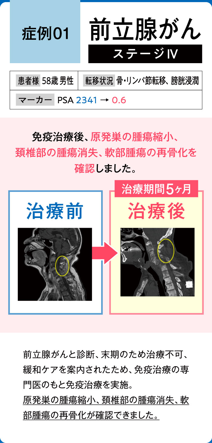 前立腺がん症例1