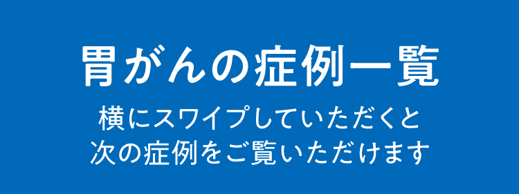 胃がんの症例一覧