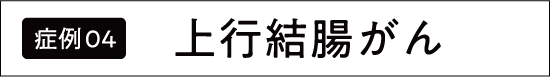上行結腸がん
