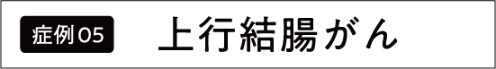 上行結腸がん