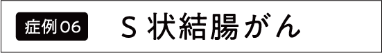 上行結腸がん