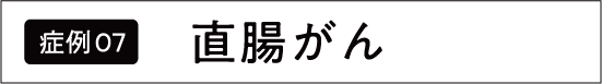 上行結腸がん