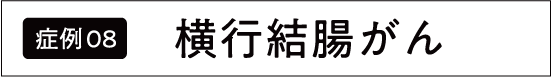 上行結腸がん