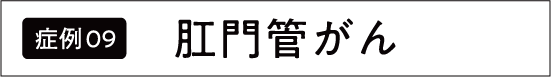 上行結腸がん