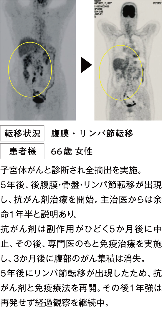その後1年強は再発せず経過観察を継続中。