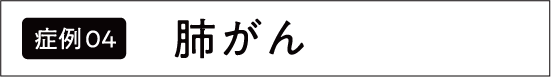 肺がん