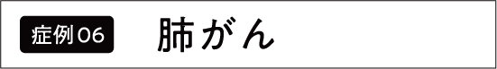 肺がん