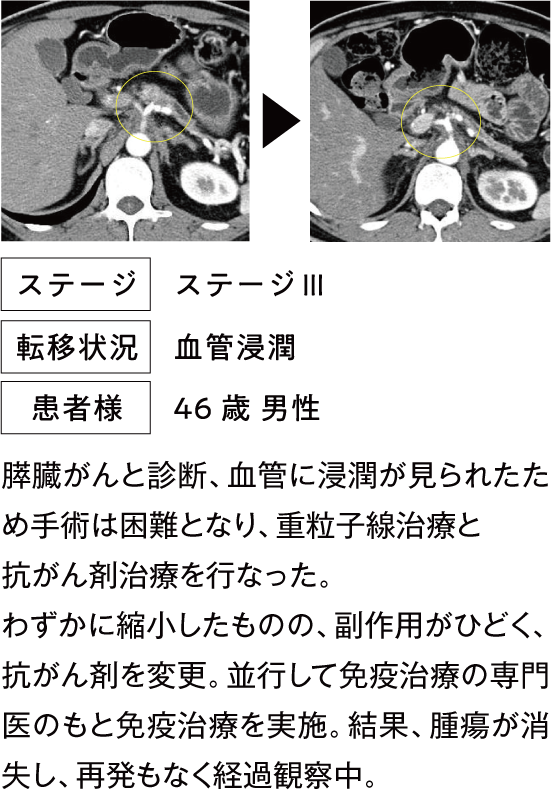 その後1年強は再発せず経過観察を継続中。