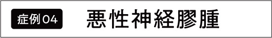 脳腫瘍